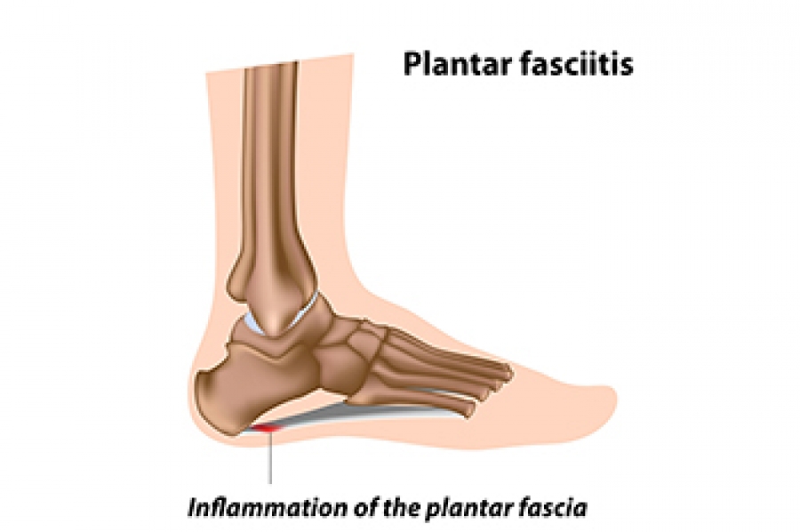The Consequences of Leaving Plantar Fasciitis Untreated - Plantar Fasciitis